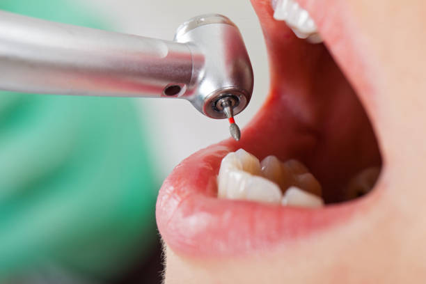 Best Emergency Dentist for Lost Fillings or Crowns in Maury, NC